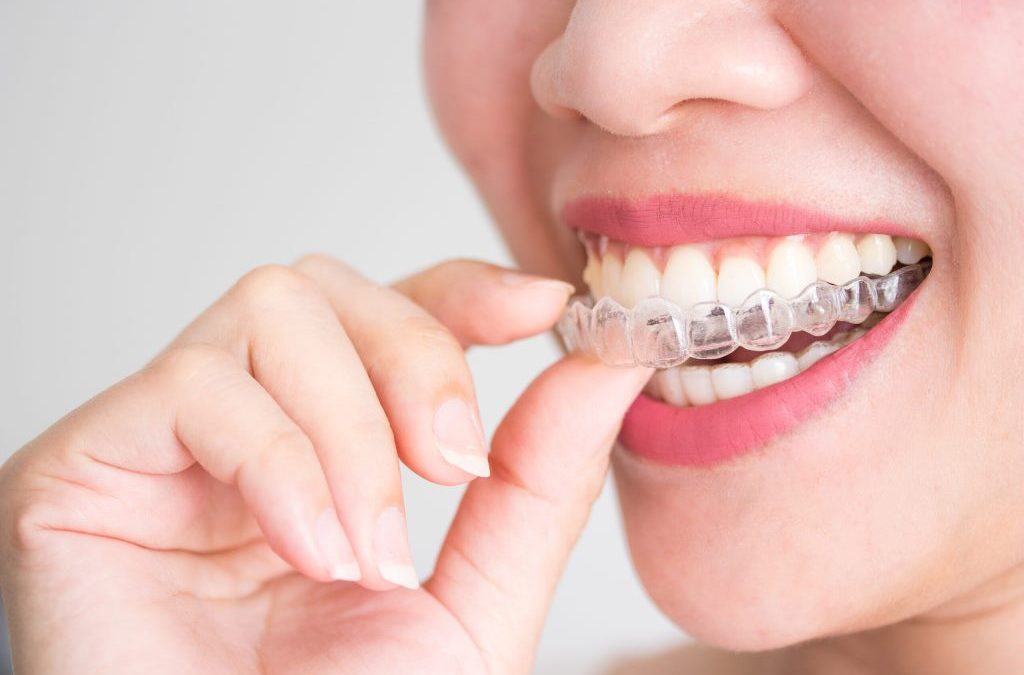 Your Personal Invisalign Journey!