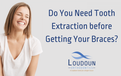 Do I Need Tooth Extraction Before Getting Braces?