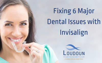 Fixing 6 Major Dental Issues With Invisalign!
