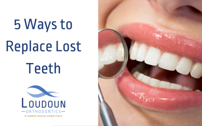 5 Ways to Replace Lost Teeth