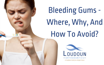 Bleeding Gums – Where, Why, And How To Avoid
