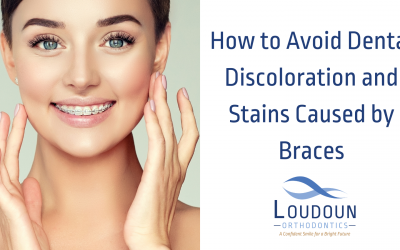 How to Avoid Dental Discoloration and Stains Caused by Braces