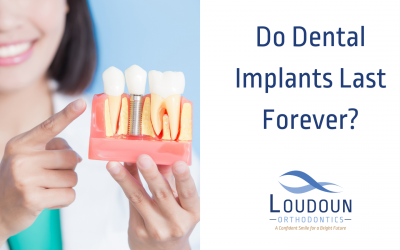 Do Dental Implants Last Forever?