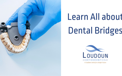 Learn All about Dental Bridges