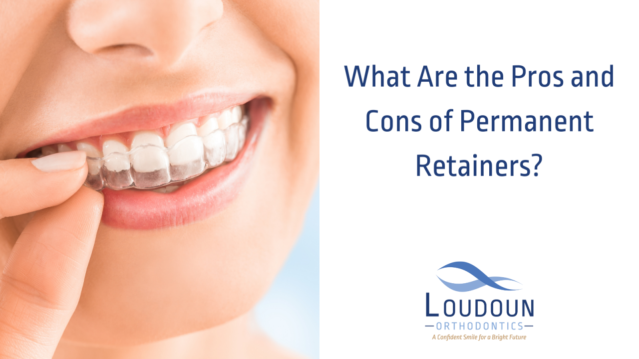 What Are the Pros and Cons of Permanent Retainers?