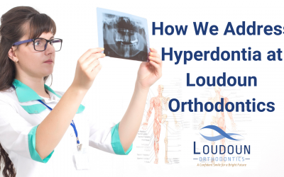 How We Address Hyperdontia at Loudoun Orthodontics