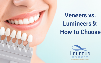 Veneers vs. Lumineers®: How to Choose