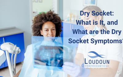 Dry Socket: What is It, and What are the Dry Socket Symptoms?