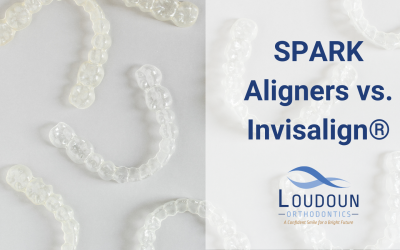 SPARK Aligners vs. Invisalign