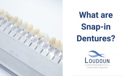 What are Snap-in Dentures?