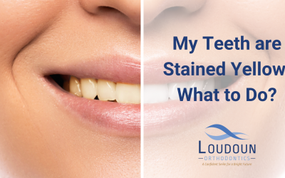 My Teeth are Stained Yellow: What to Do?