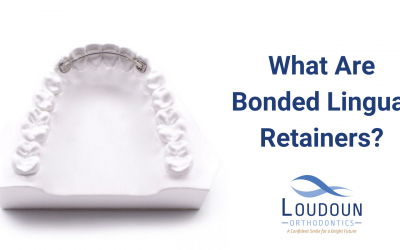 What Are Bonded Lingual Retainers?