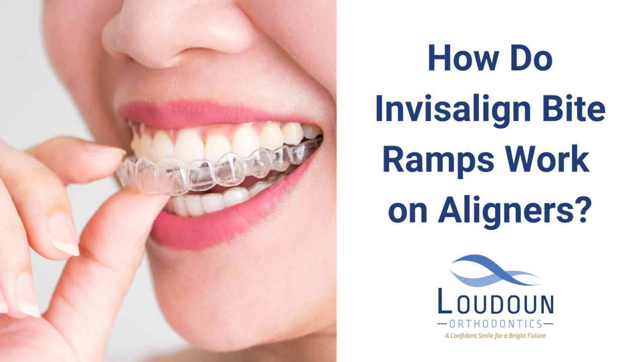 How Do Invisalign Bite Ramps Work on Aligners?