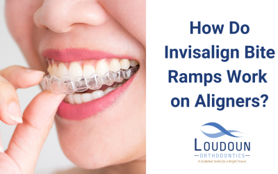 How Do Invisalign Bite Ramps Work on Aligners?