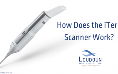 How Does the iTero Scanner Work?