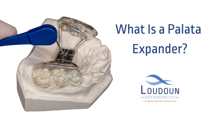 What is a Palatal Expander?