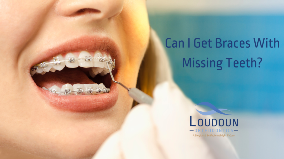 Can I Get Braces With Missing Teeth?