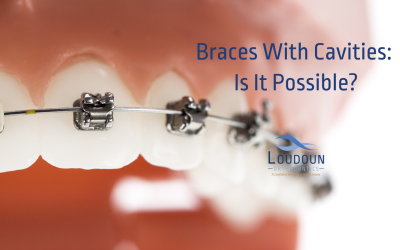 Braces With Cavities: Is It Possible?