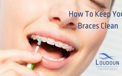 How to Keep Your Braces Clean
