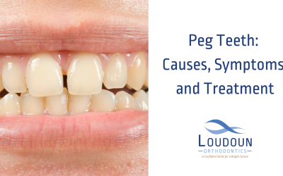 Peg Teeth: Causes, Symptoms, and Treatment