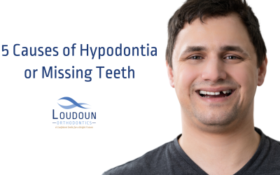 5 Causes of Hypodontia or Missing Teeth