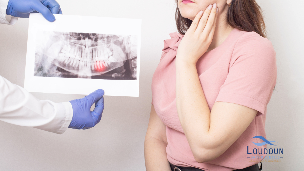 Impacted Wisdom Teeth: Symptoms and Treatment Options | Loudoun ...