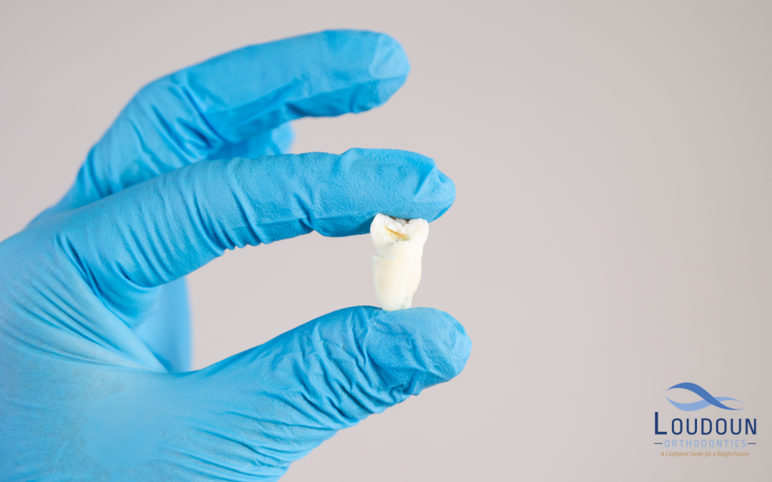 What Is the Ideal Wisdom Teeth Removal Age?