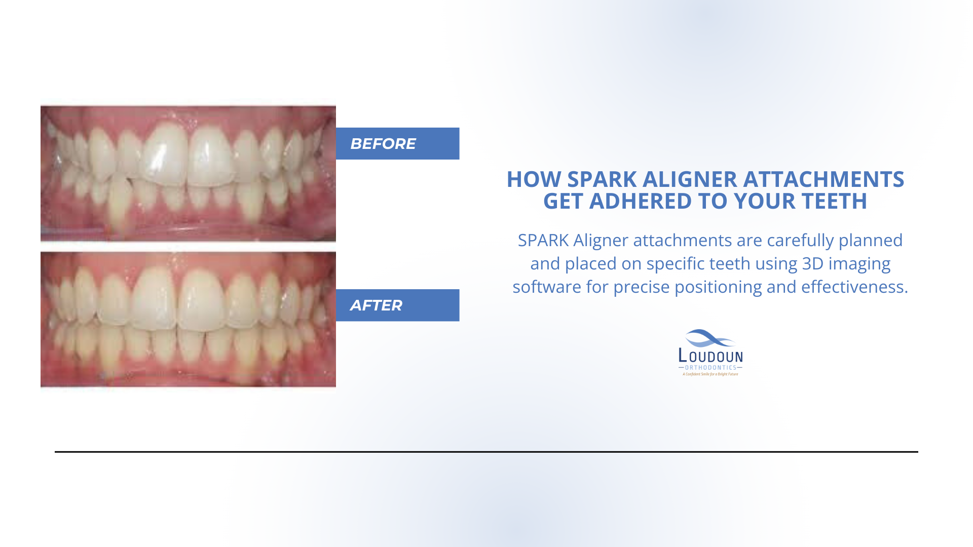 How SPARK Aligner Attachments Are Applied to Your Teeth