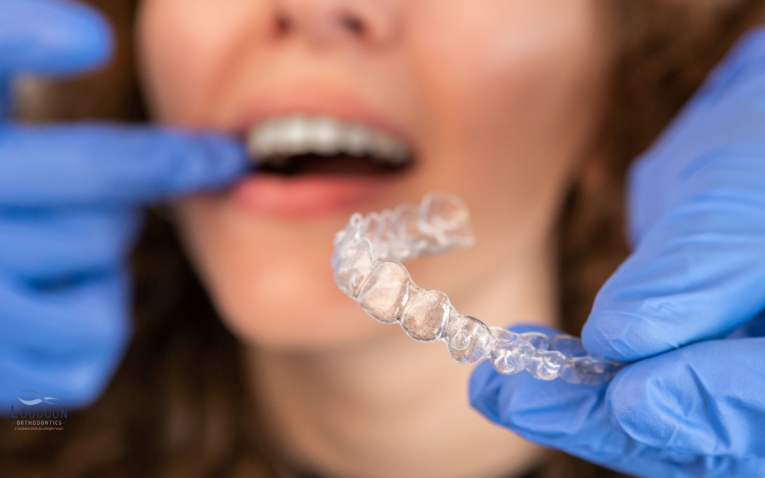 Enhancing Orthodontic Treatment: The Role of Various SPARK Aligner Attachments!