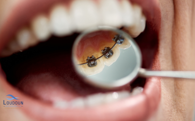 How Often Should I See My Orthodontist?