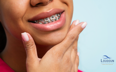 The Role of Braces in Treating Underbites: What You Need to Know