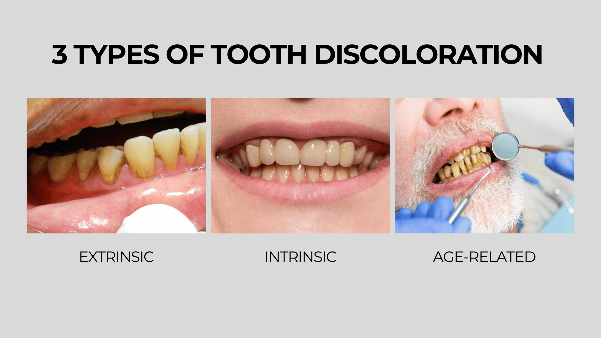 3 types of tooth discoloration