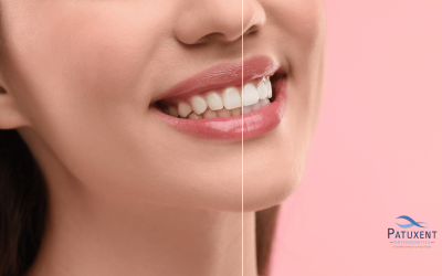 From Coffee to Genetics: 11 Causes of Tooth Discoloration